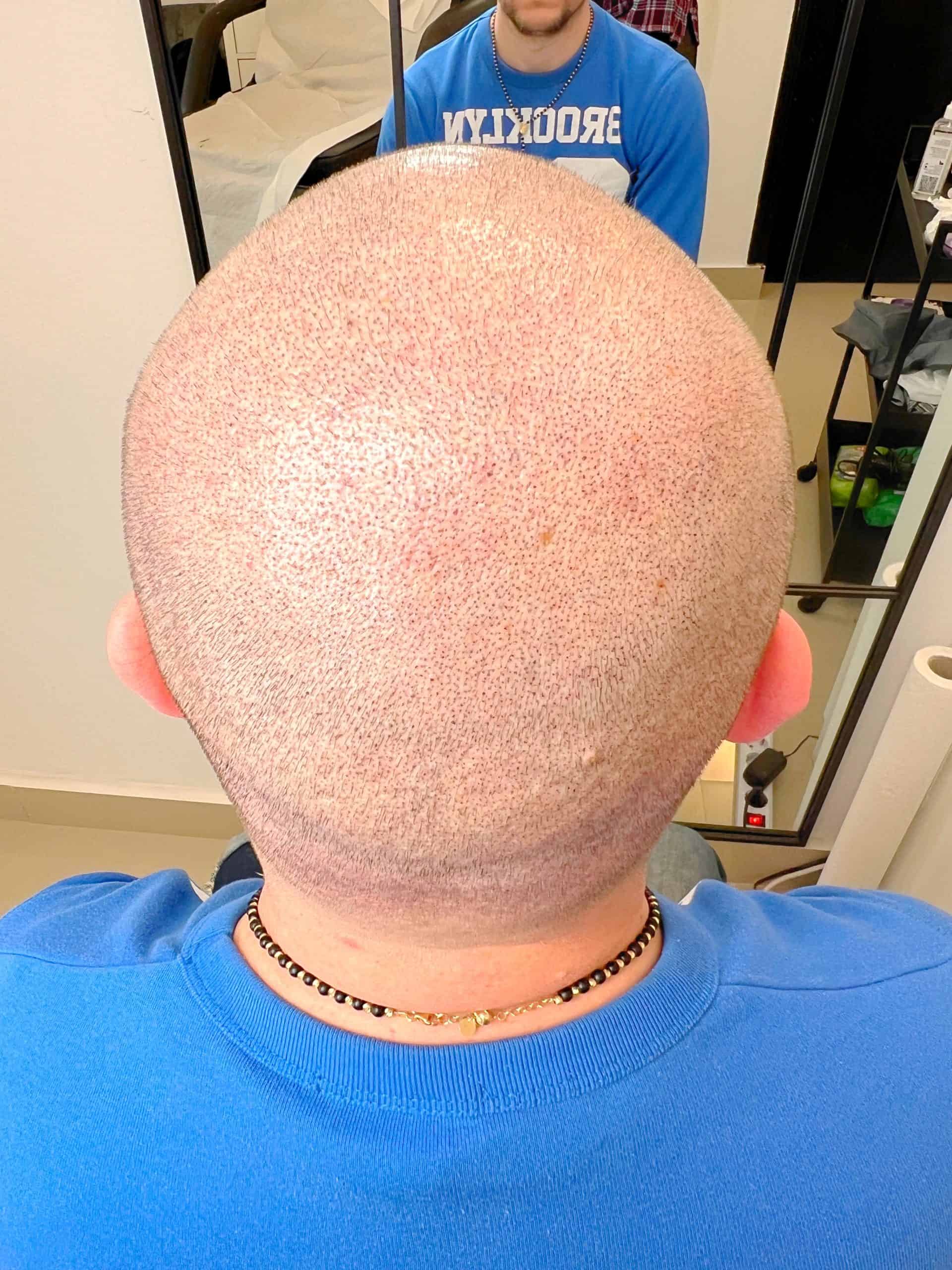 Cicatrici transplant par dupa micropigmentare scalp pret Constanta rezultat