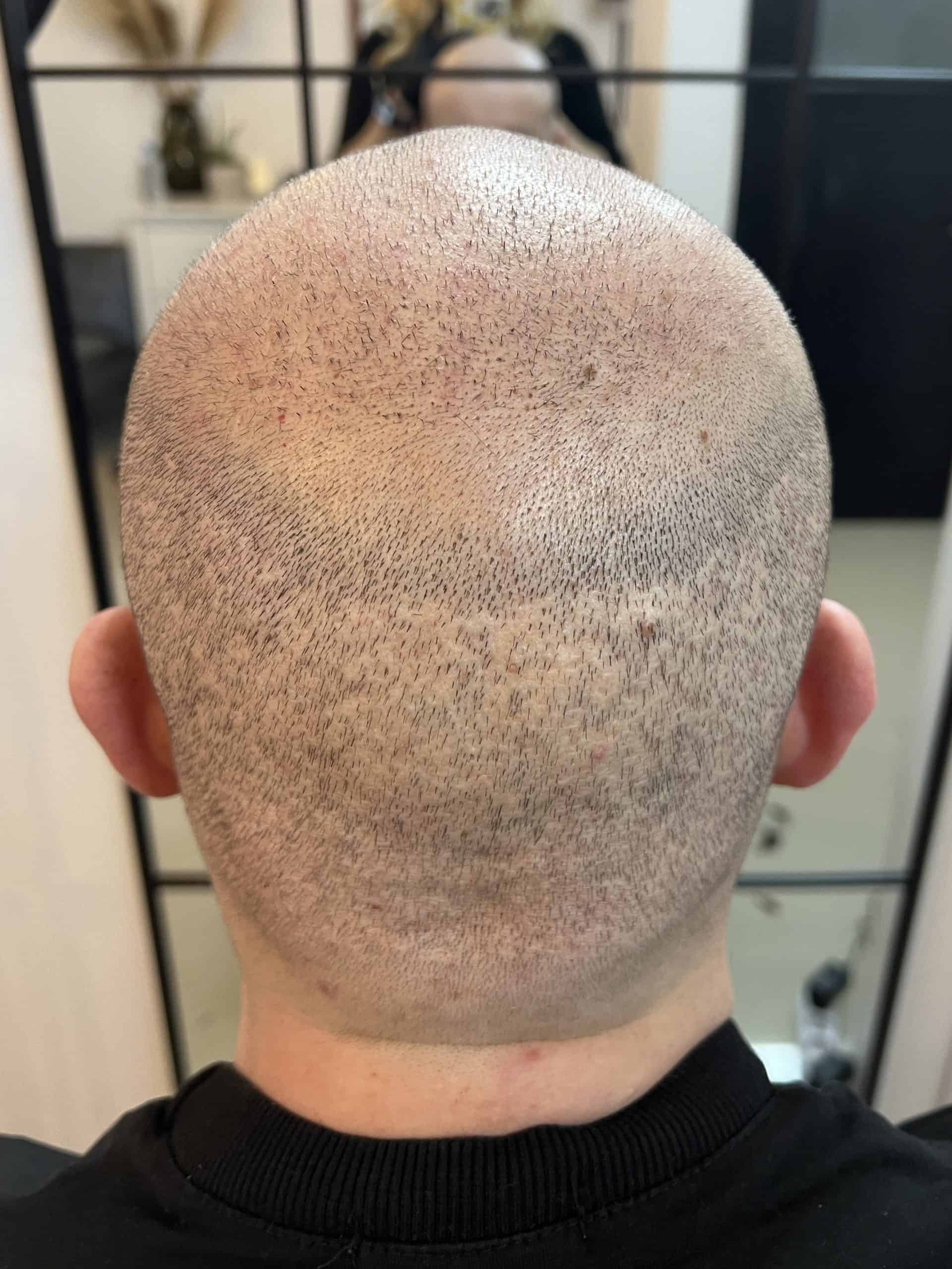 Cicatrici transplant par inainte micropigmentare scalp pret Constanta